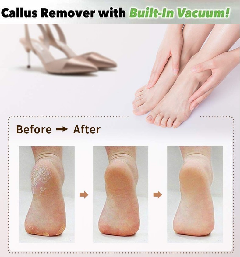 Electric Foot Grinder Callus Remover with built-in vacuum