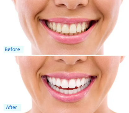 Teeth Whitening Kit